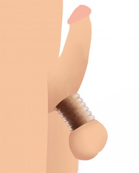 Illustration of a clear, ribbed ball stretcher ring worn around the base of the scrotum for gradual tension adjustment.